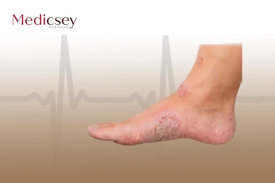 Causes and treatment of Athlete's foot in Turkey